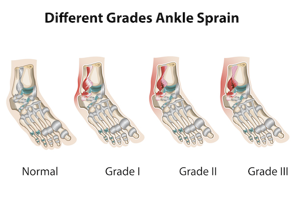 Ankle Sprains