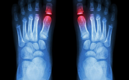 Big Toe Arthritis