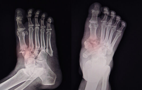 Broken Toe X-Ray