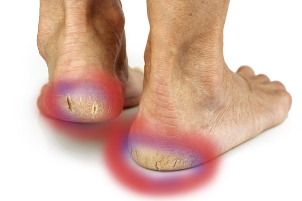 Cracked Heels