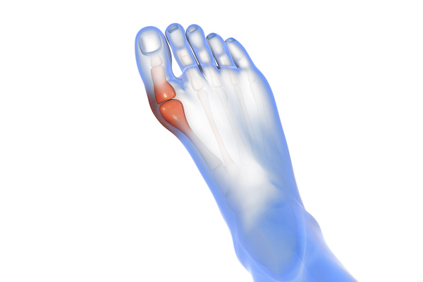 Hallux Valgus