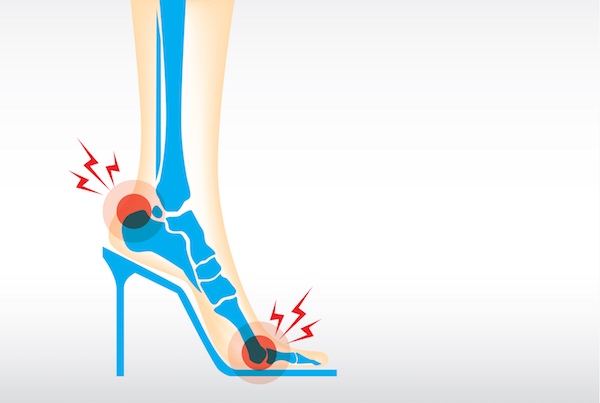 High Heels Foot Pain