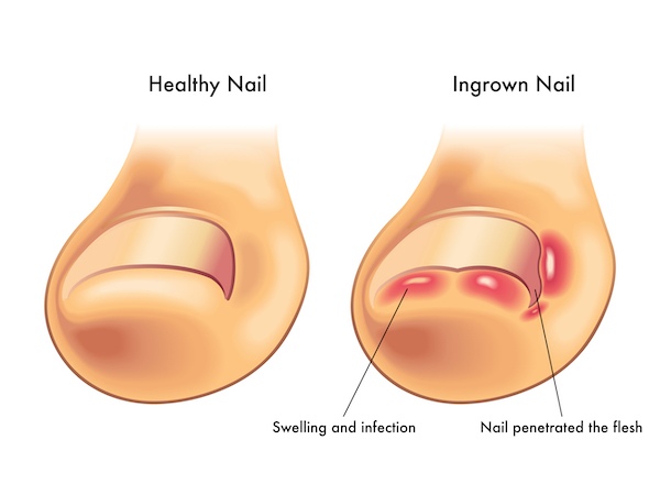 Ingrown Toenail
