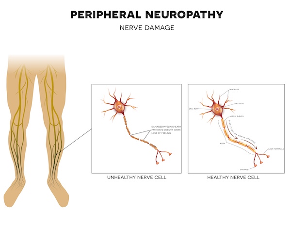 Peripheral Neuropathy