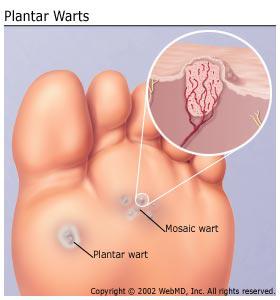 Plantar Warts What They Are And How To Treat Them Foot Care Products Footdocstore