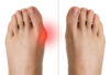 What Causes Bunions